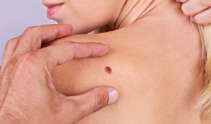 Prevenzione del melanoma, 3 appuntamenti a luglio